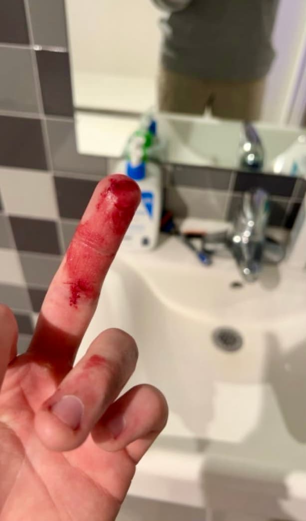Bloody finger
